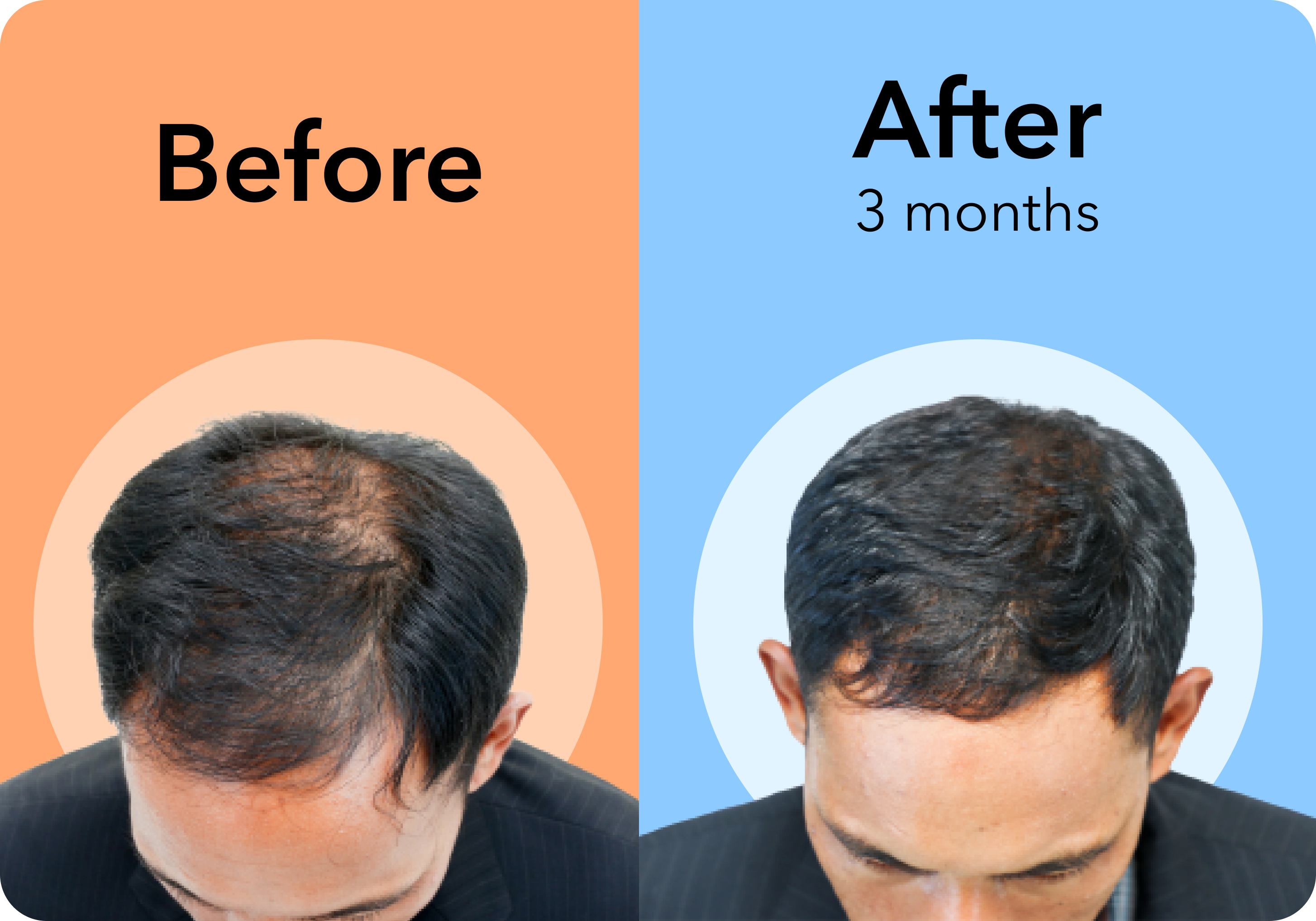 Hair Loss Prevention and Treatment